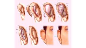 Как исправить оттопыренное ухо