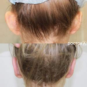 Результат отопластики (до и после первичной реабилитации). Работа Амджада Аль Юсефа.