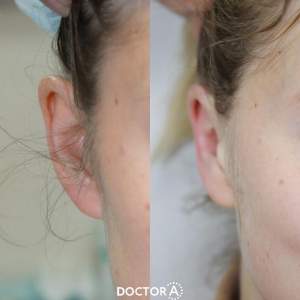 Результат отопластики (до и после реабилитации). Работа Амджада Аль Юсефа.