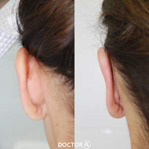 Результат отопластики (до и через 10 дней после операции). Работа Амджада Аль Юсефа.