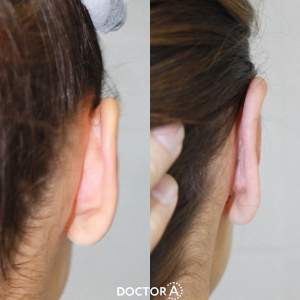 Результат отопластики (до и через 10 дней после операции). Работа Амджада Аль Юсефа.