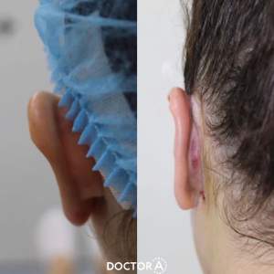 Результат отопластики (до и после операции). Работа Амджада Аль Юсефа.