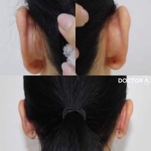 Результат отопластики (до и через 10 дней после операции). Работа Амджада Аль Юсефа.