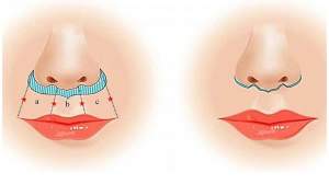 Во время коррекции хирург делает надрез прямо у основания носа, который по форме напоминает рога быка.