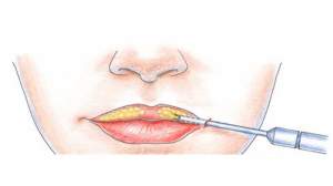 Липофилинг