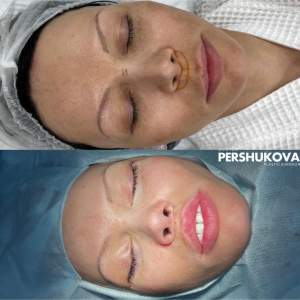 Комплексная пластика лица: нижняя блефаропластика + подтяжка средней зоны «чек-лифт» + пластика губ по Булхорну: до и сразу после операции. Работа Анны Петровны Першуковой