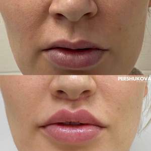 Липопластика Булхорн: до и после первичной реабилитации. Работа Анны Петровны Першуковой