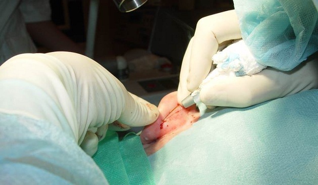 Отопластика лазером – эффективный и современный метод коррекции лопоухости у детей Отопластика лазером – эффективный и современный метод коррекции лопоухости у детей