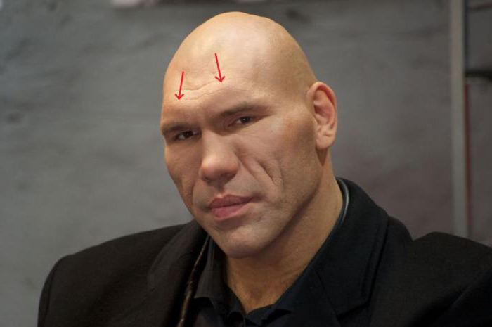 выступающие выступы на лбу