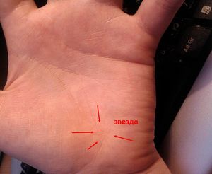 Hvordan forstå betydningen av føflekker Hva betyr en føflekk i håndflaten din