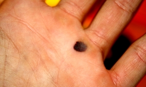 Hvor er linjen med barn på hånden Varianter av føflekker