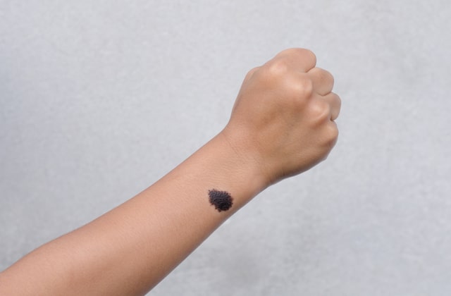 родинка на руке родинка на руке