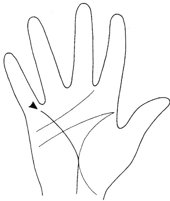 Линия здоровья, пересекающая линию жизни, считается неблагоприятным знаком