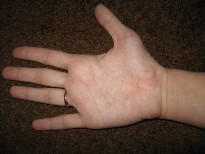 Оборванная линия жизни часто сигнализирует о проблемах со здоровьем