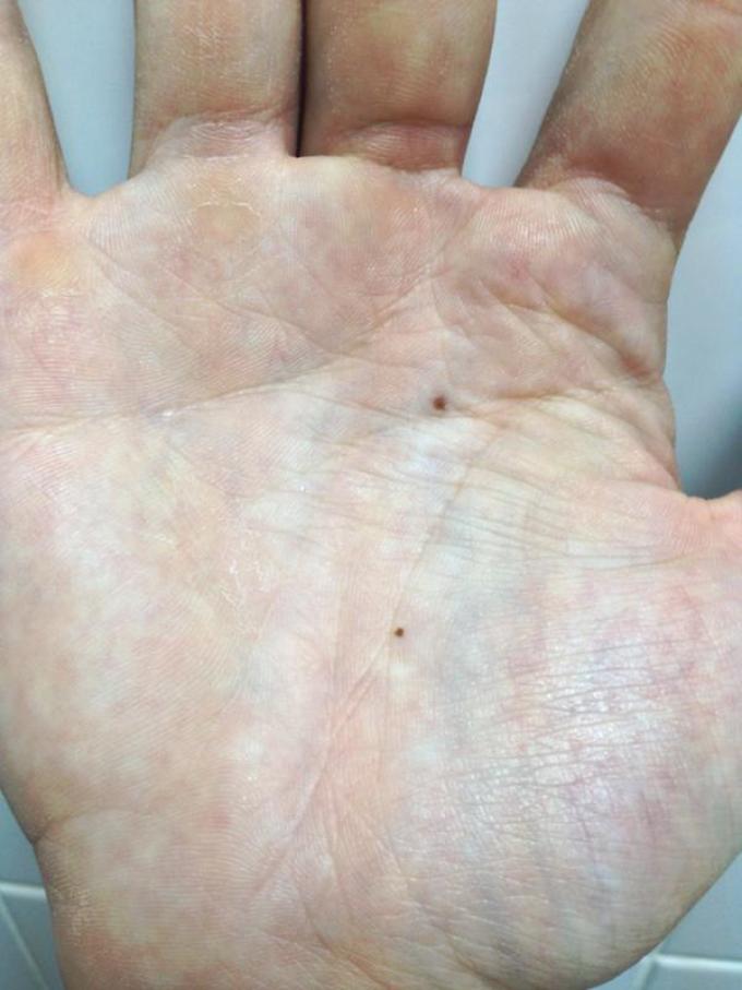 Родинка на линии жизни предсказывает болезнь